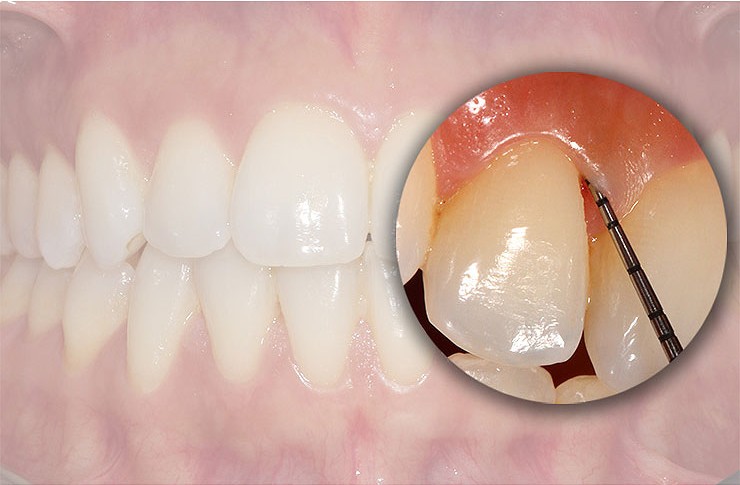 Periodontal disease