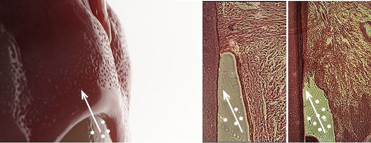 Periodontal disease