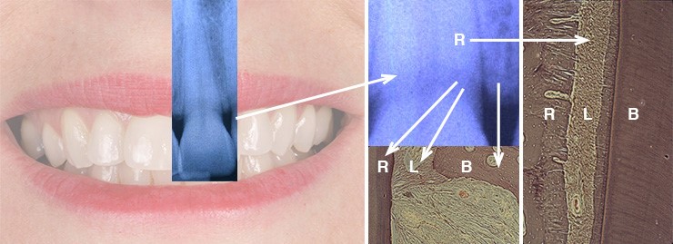 Periodontal disease